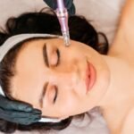 Radiofrequency Microneedling for Skincare
