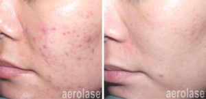 Advanced Laser Skin Therapy Cairns