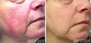 Aerolase Rosacea Skin Treatment