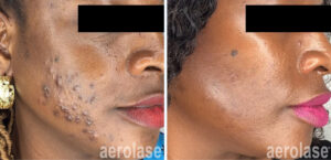 Aerolase Skin Rejuvenation Cairns