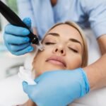 PRP Microneedling Facial