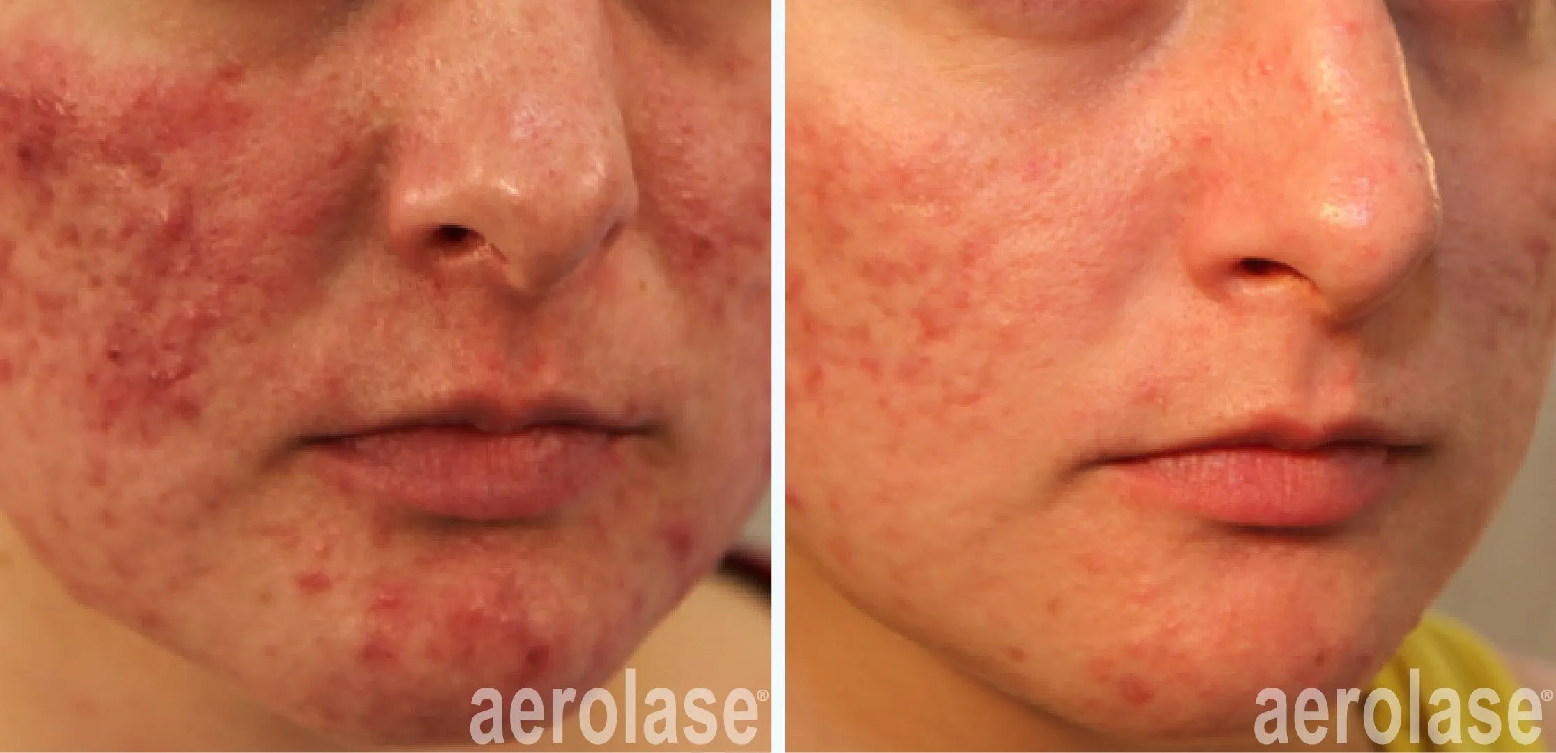 acne redness before and after