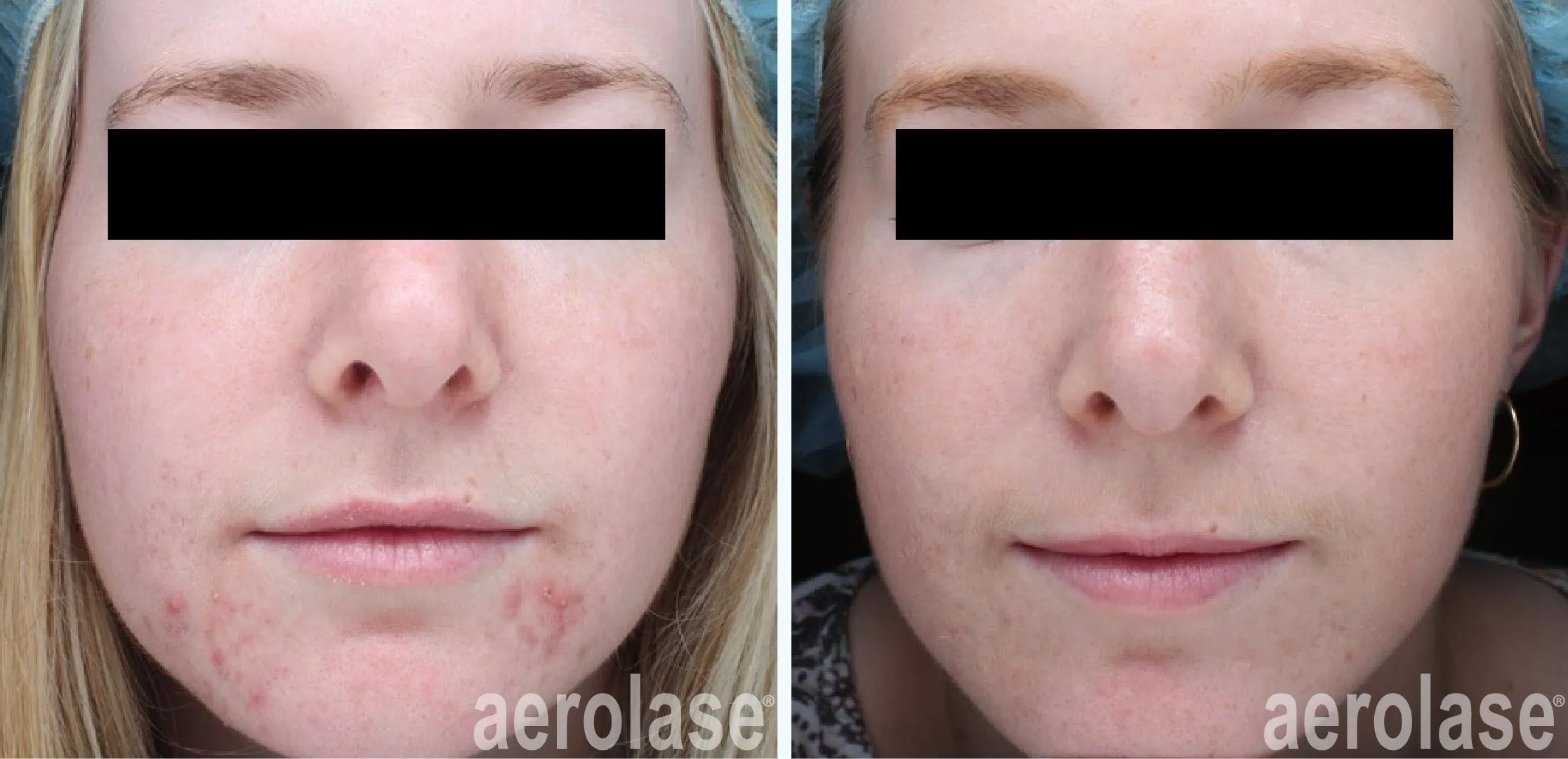 acne before and after treatment