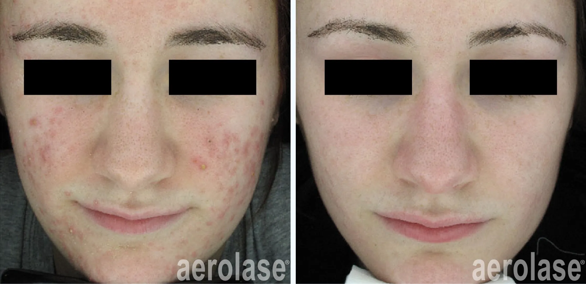 acne treatment