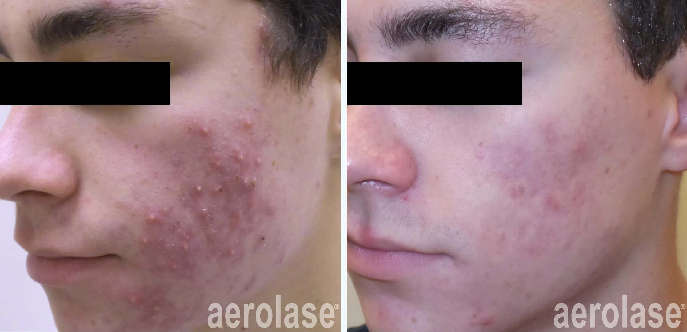 acne cheeks before and after treatment