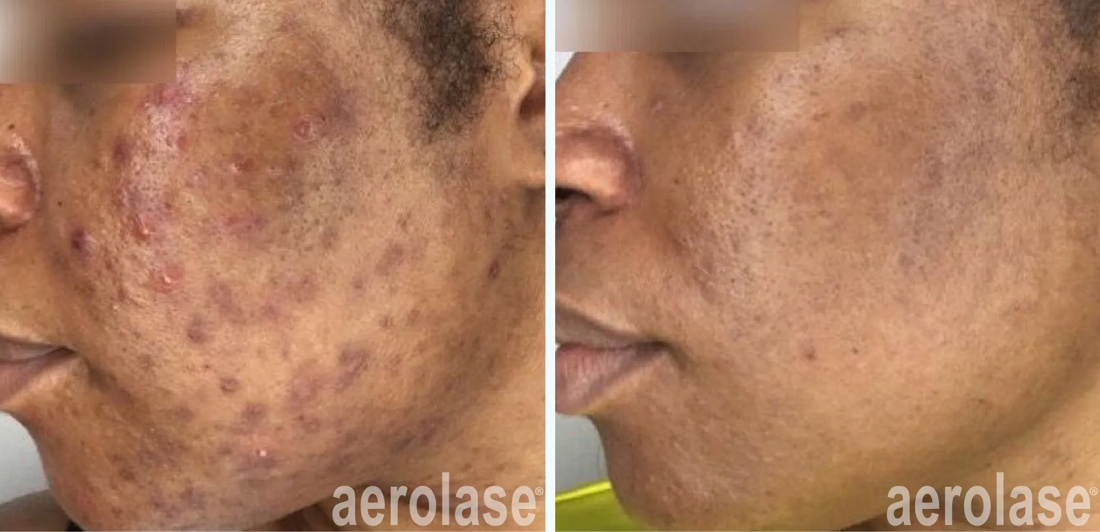 acne cheeks skin of color before and after
