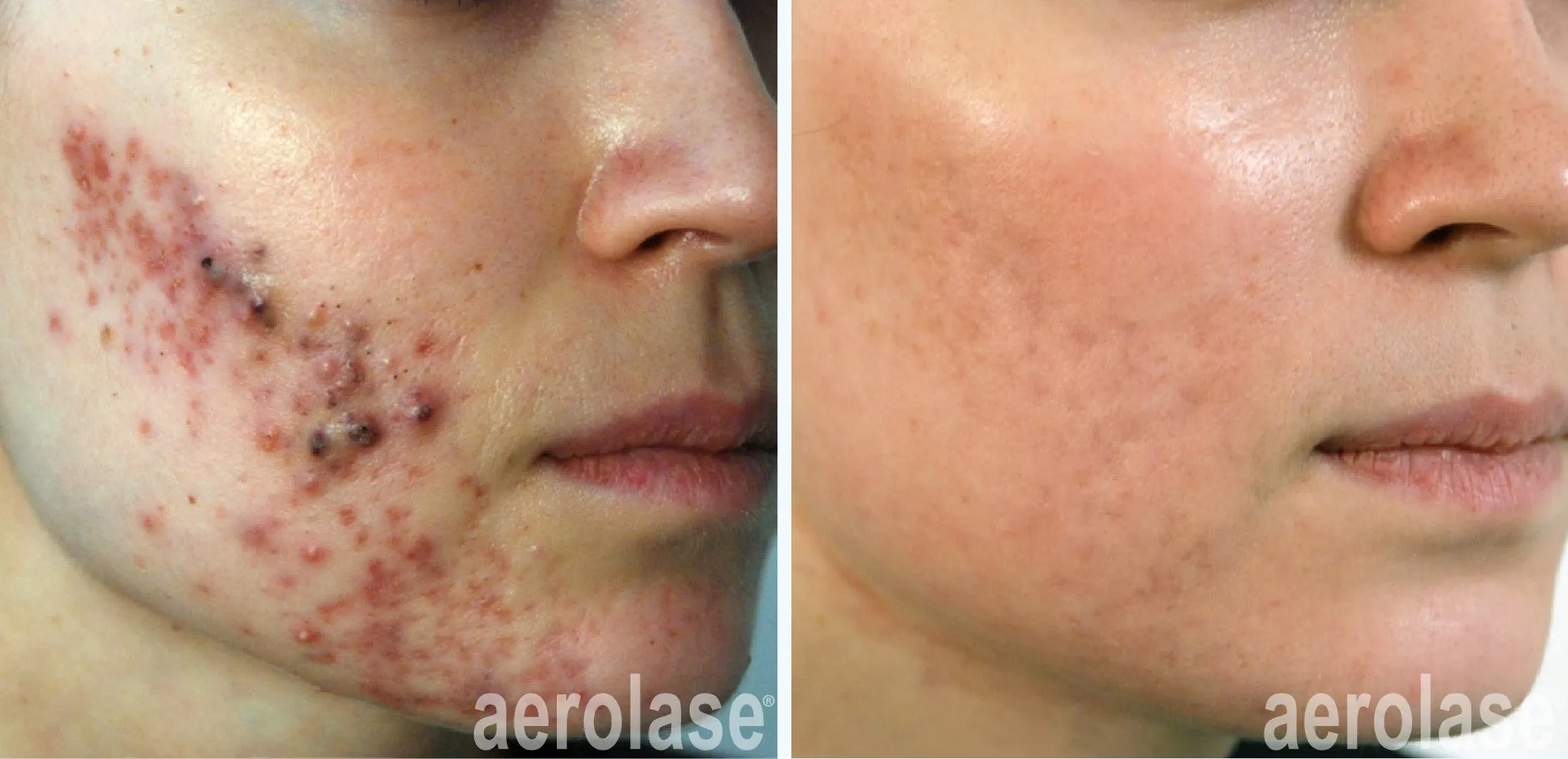 acne cheeks with isotretinoin
