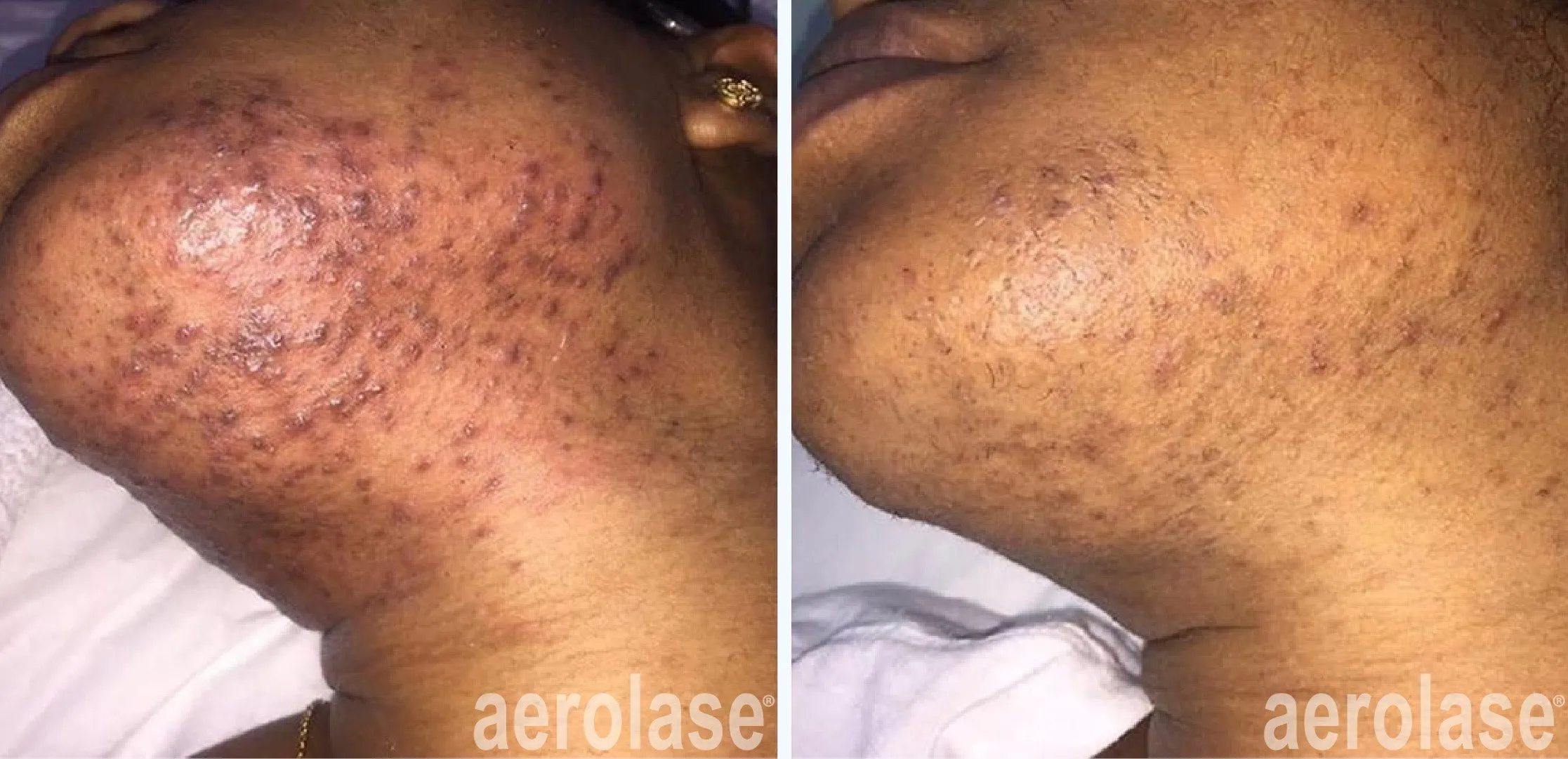 acne chin treatment