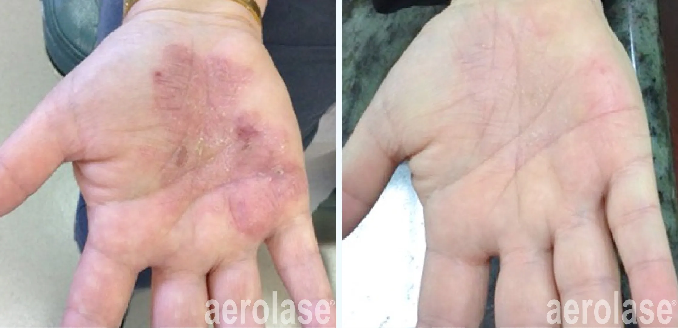 Psoriasis Treatment