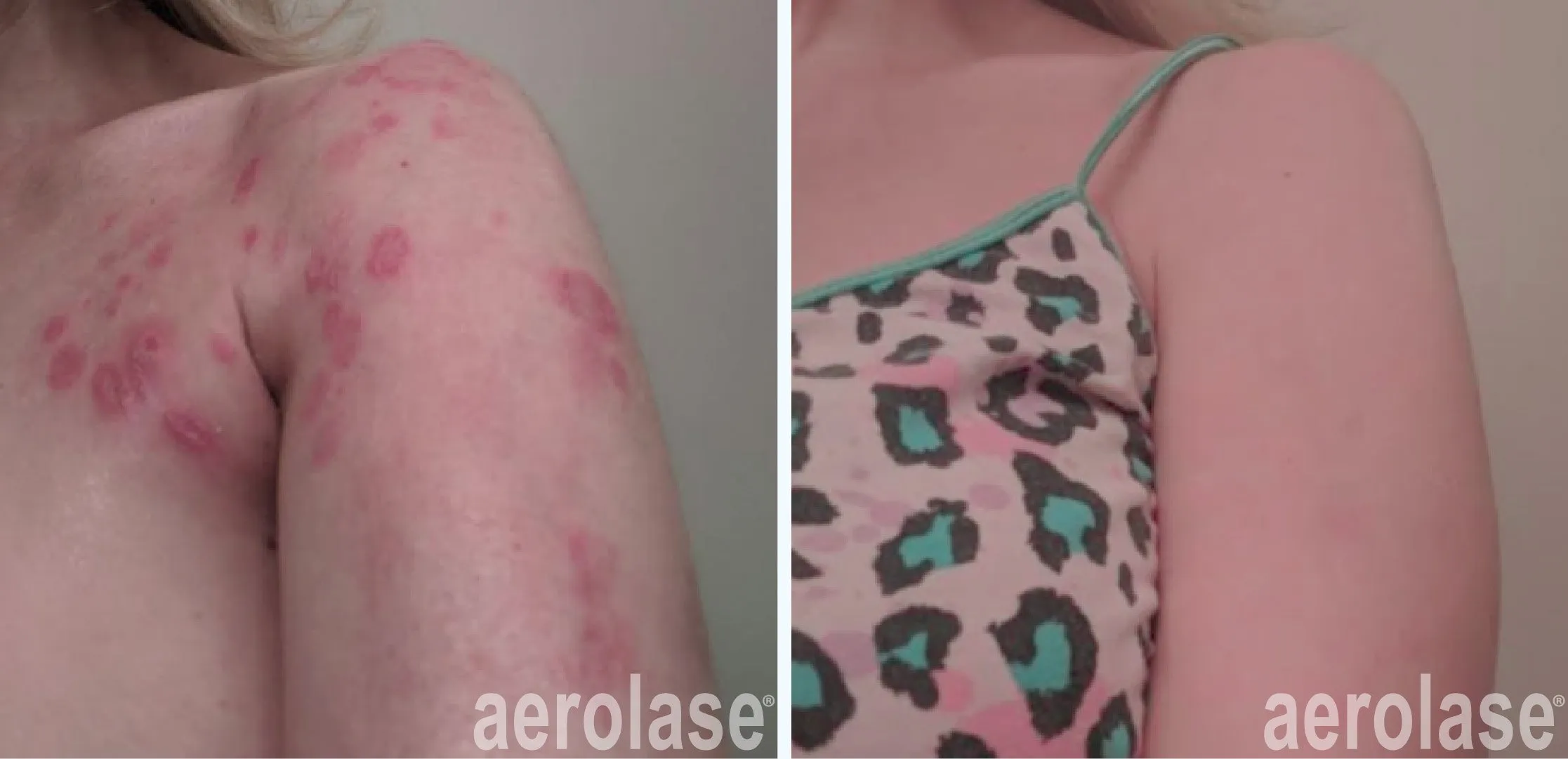 Psoriasis Treatment before and after
