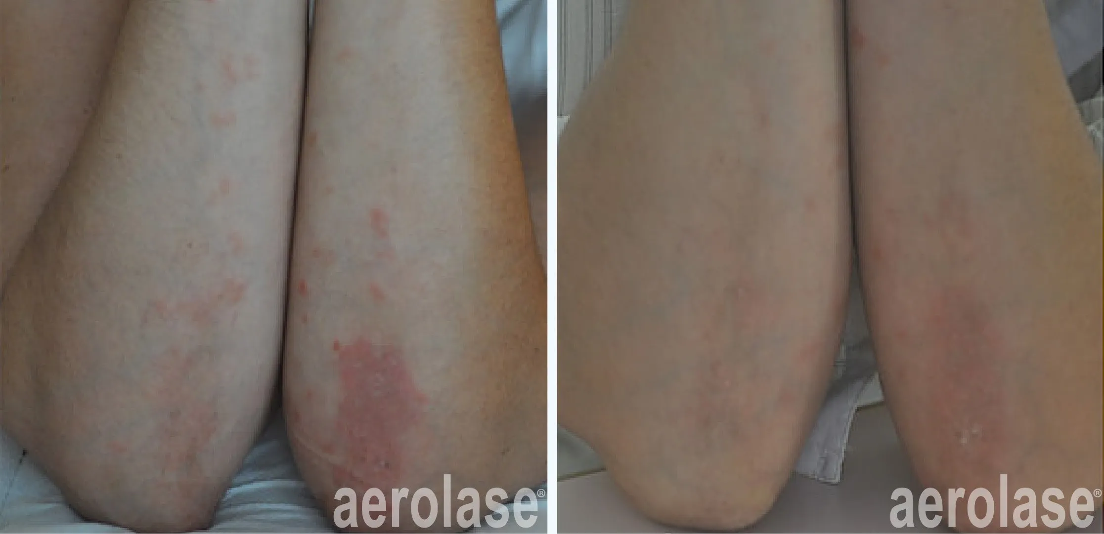 Psoriasis Treatment in Cairns