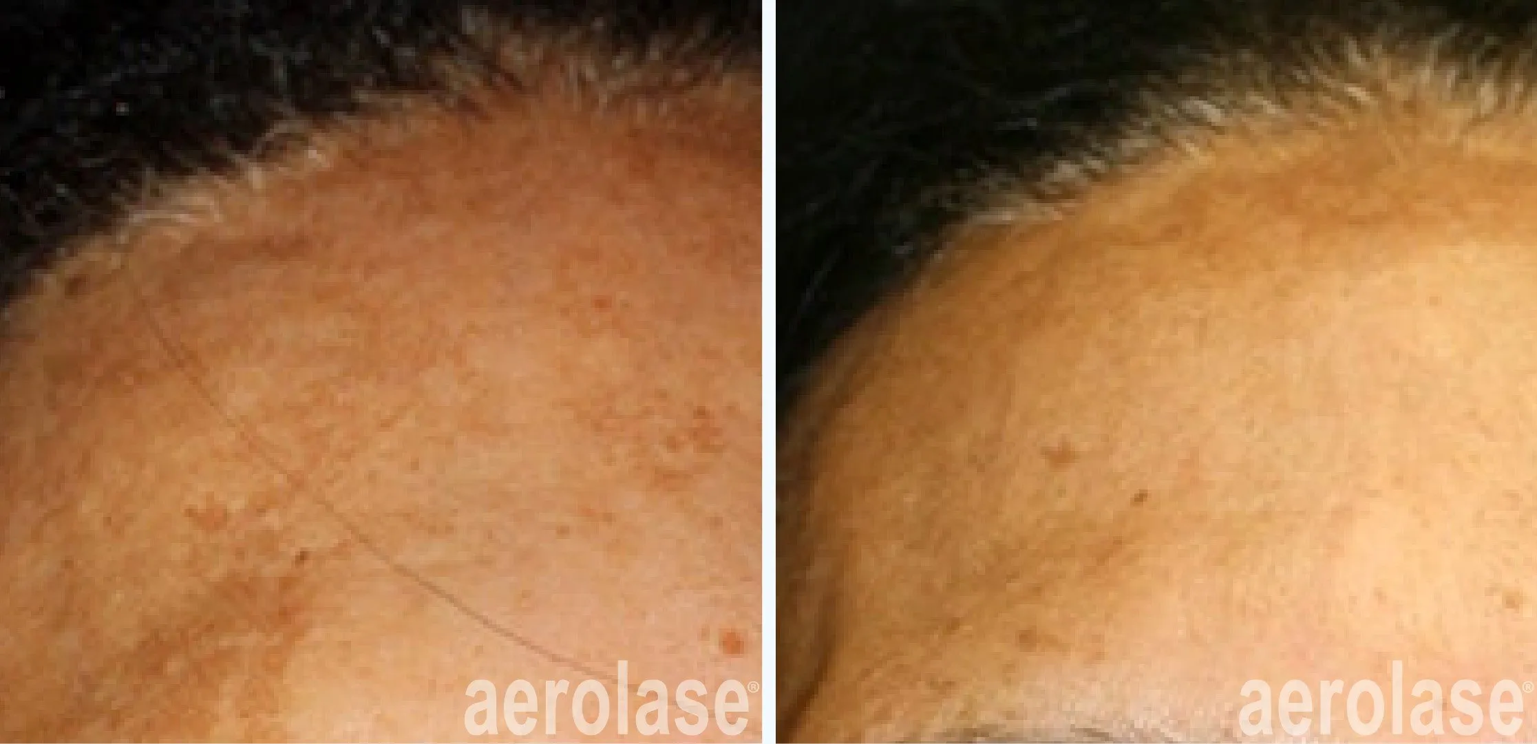 best melasma treatment Cairns