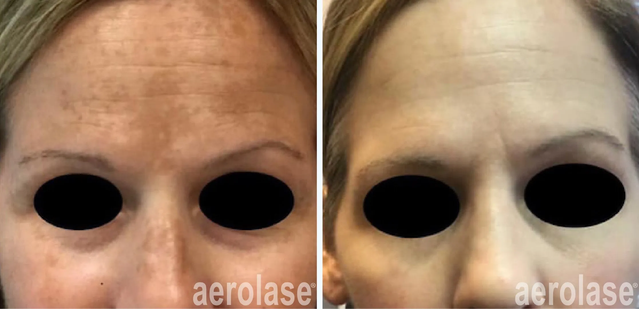Melasma hyperpigmentation Treatment