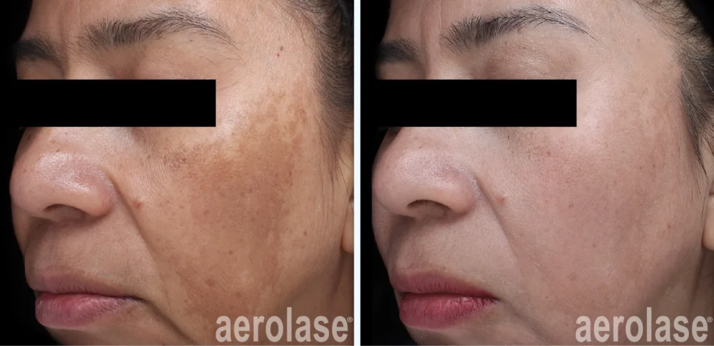 best melasma treatment in Cairns