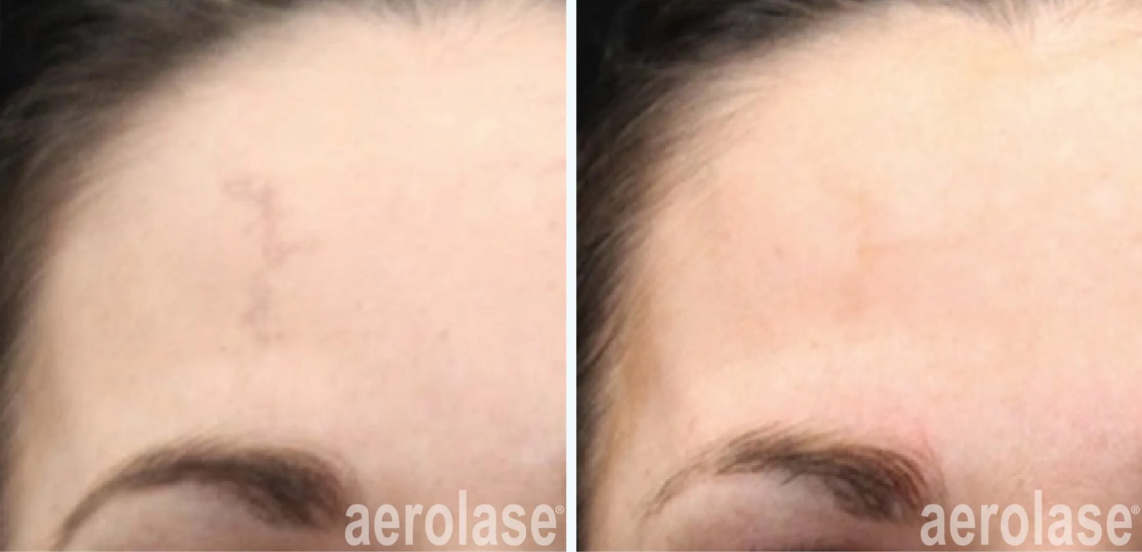 melasma treatment