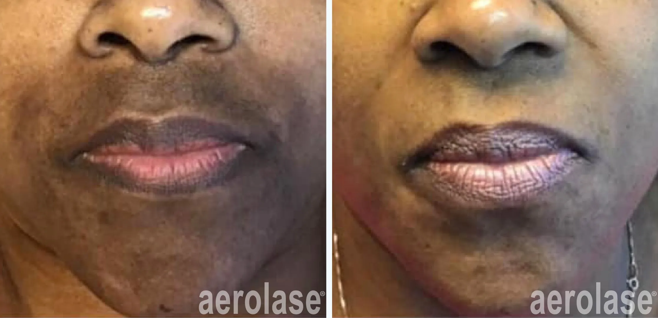 Melasma Lip Treatment