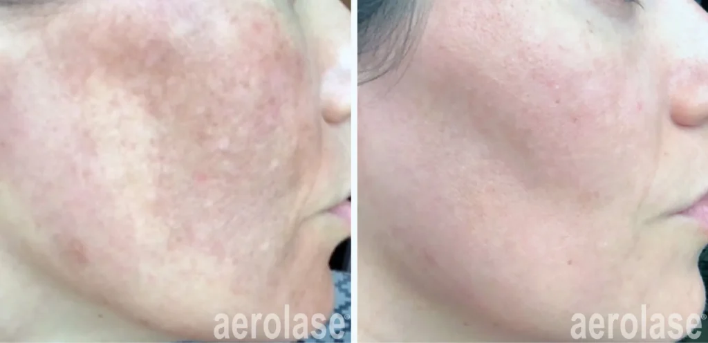 best melasma treatment