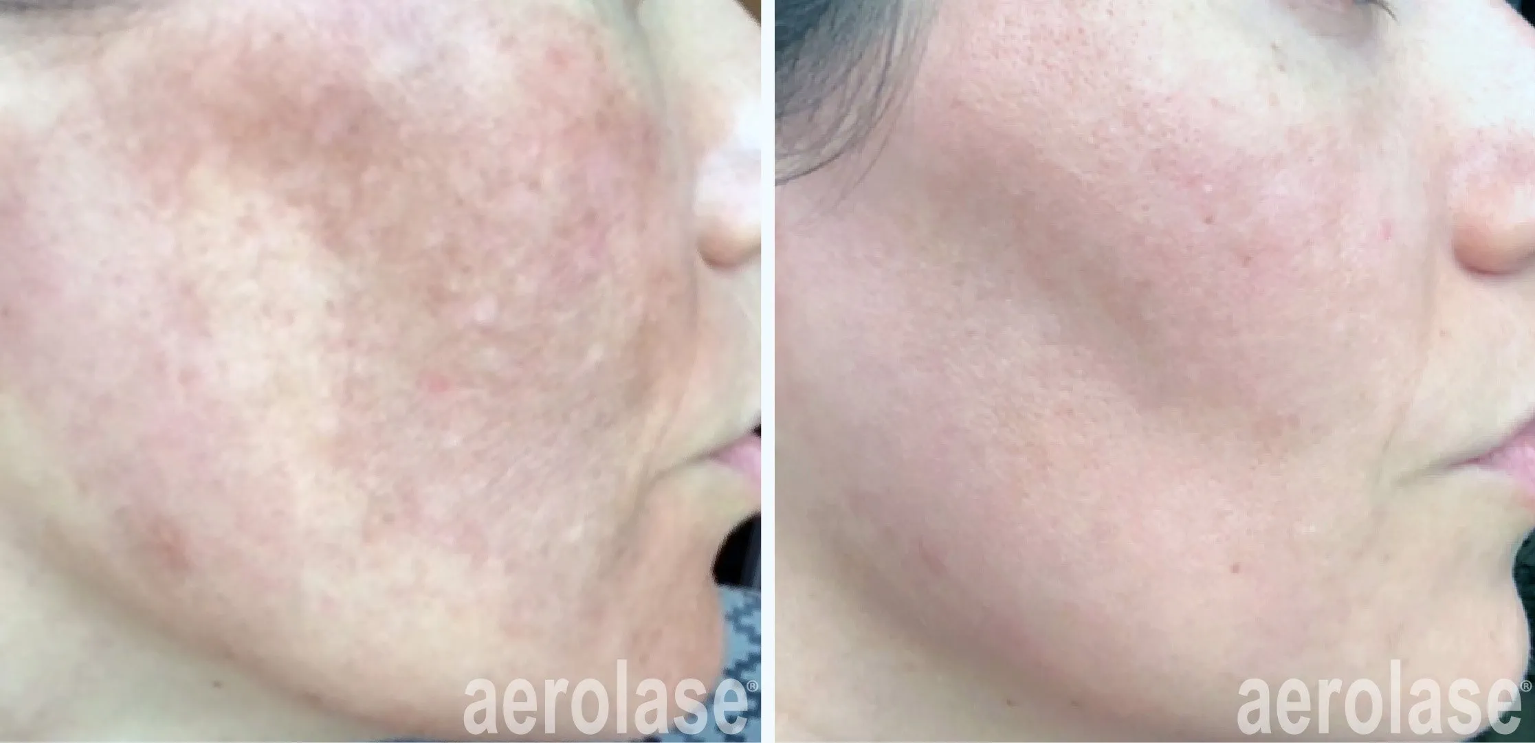 best melasma treatment