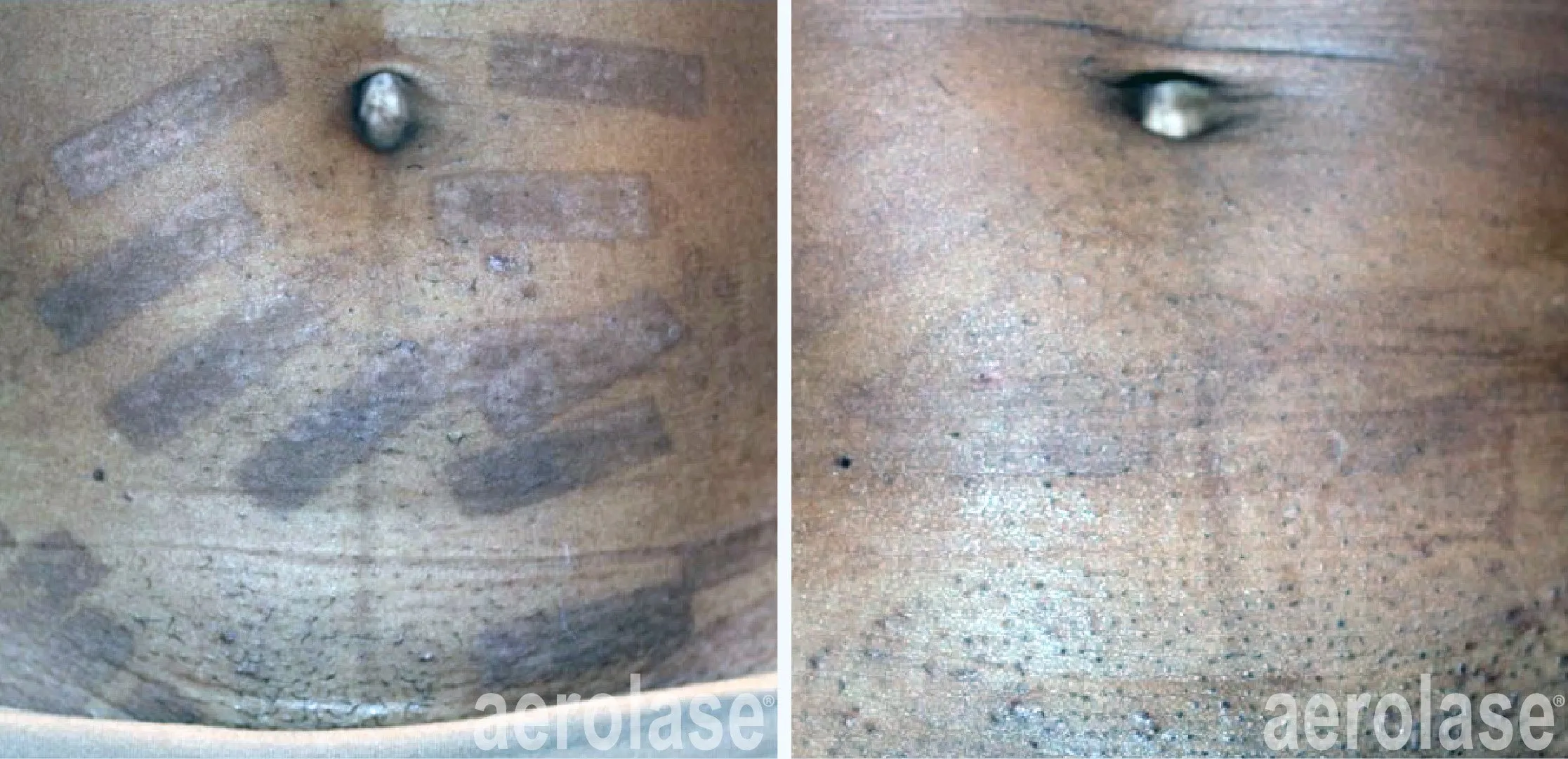 Pigmentation Treatment