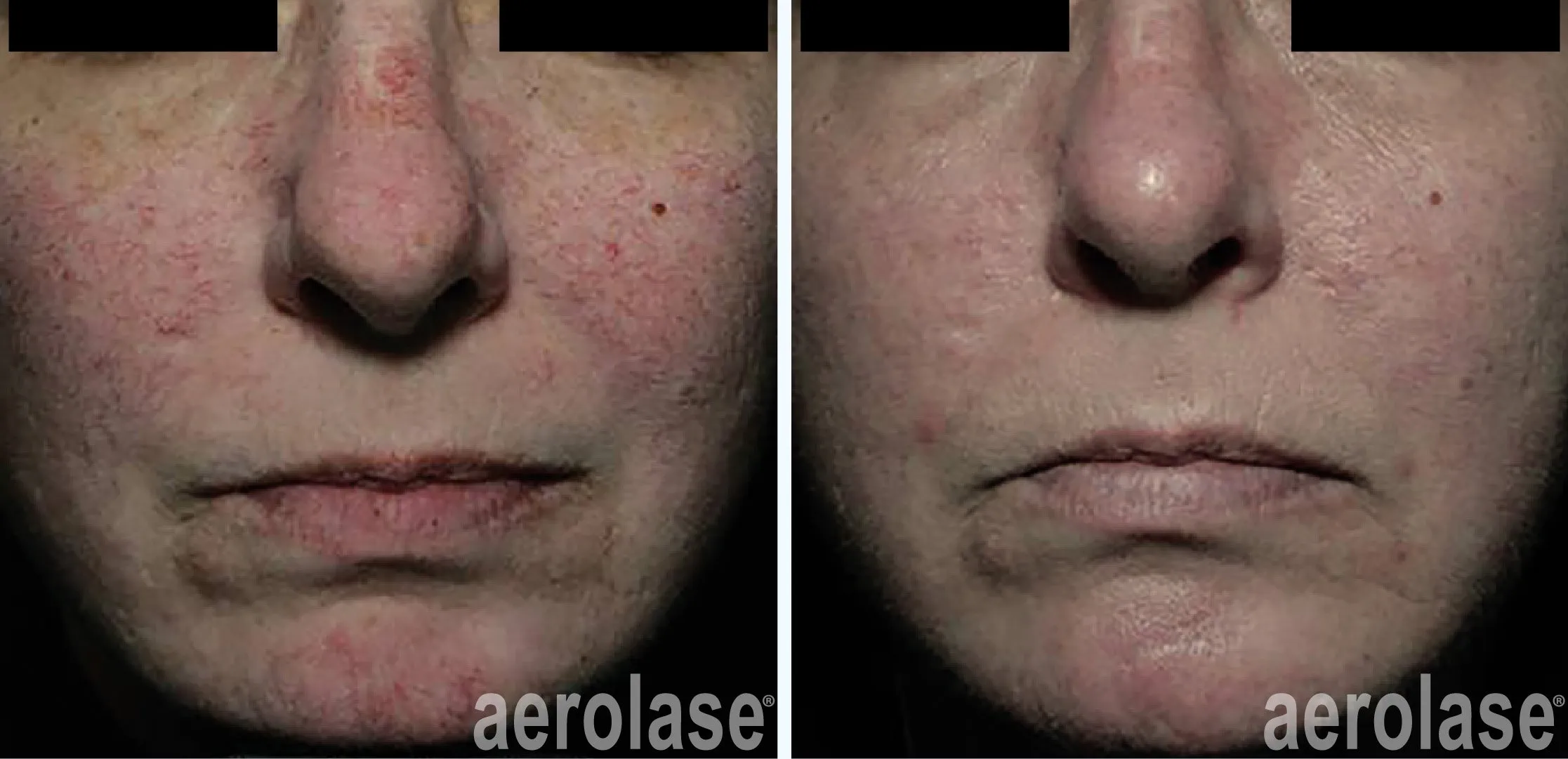 Redness after skin needling treatment