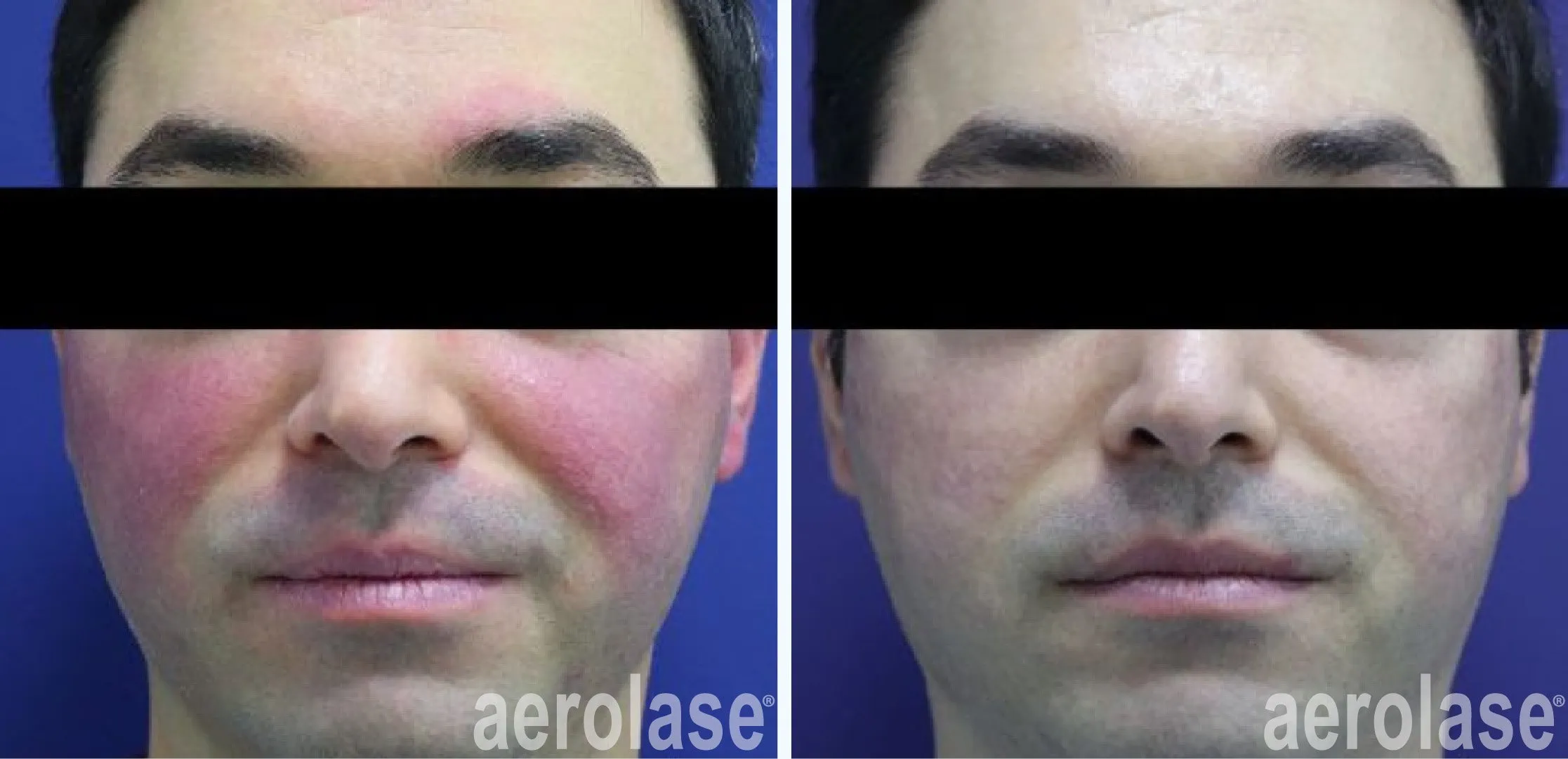 Redness skin needling treatment
