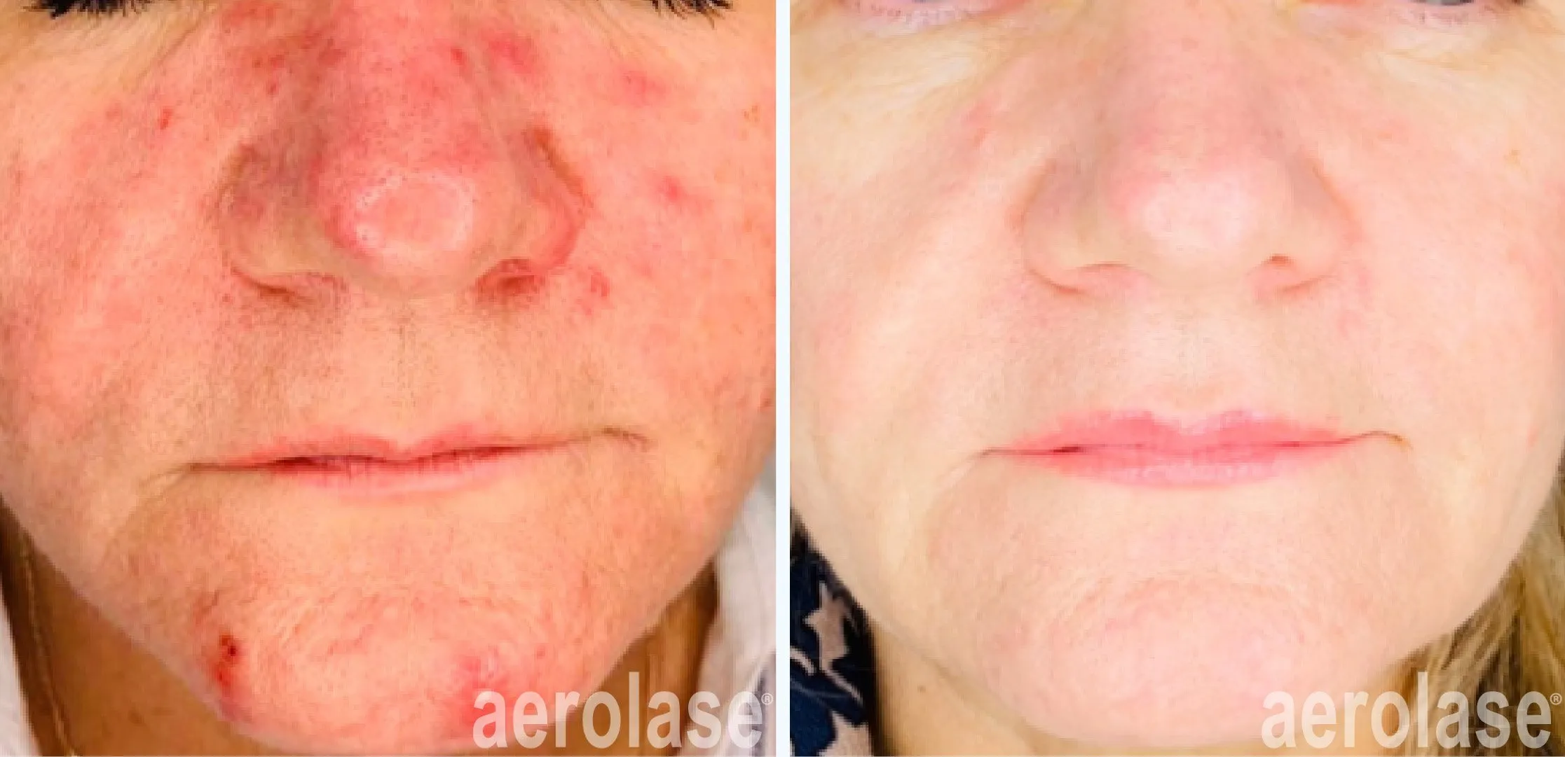 Mild redness after facial needling