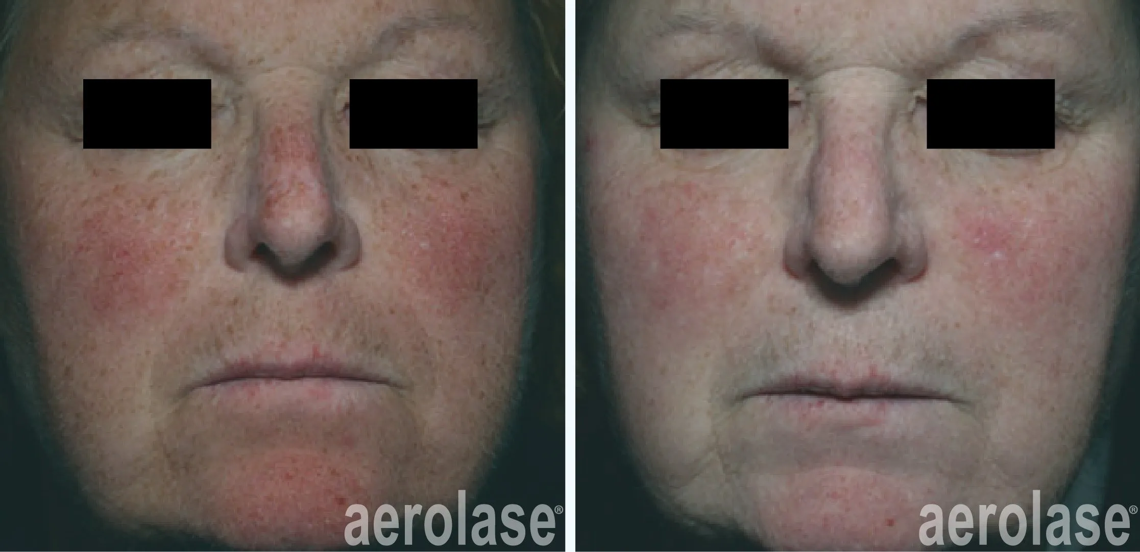 Facial Treatments