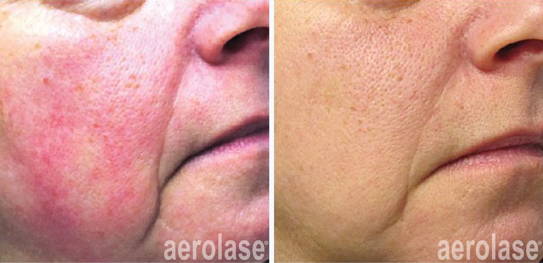 Skin Redness Treatment