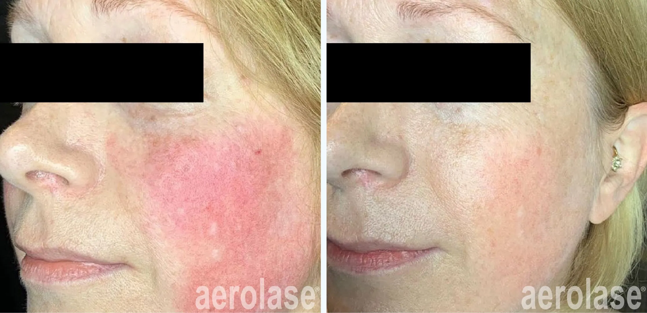 Redness reduction therapy