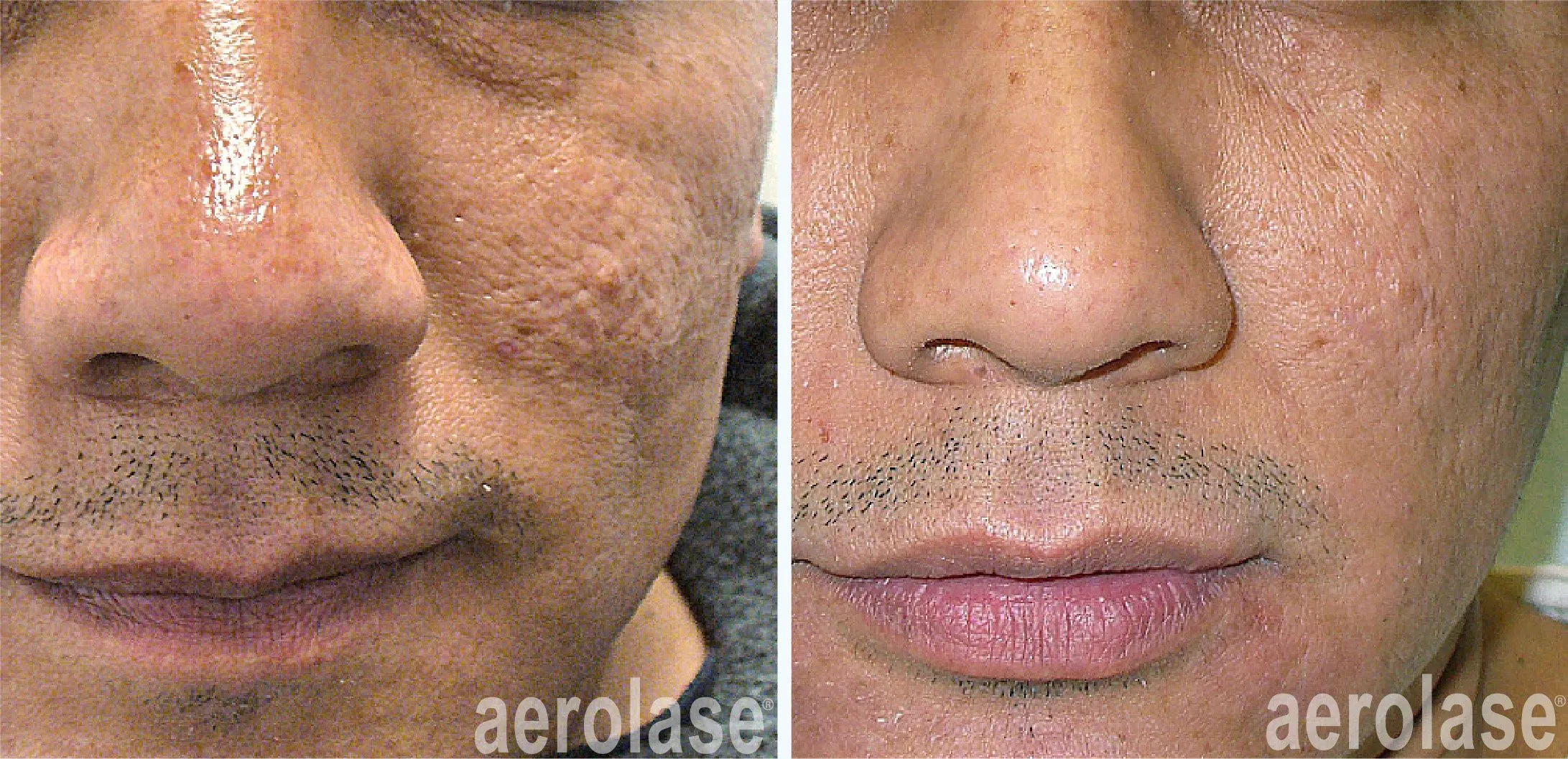 Skin Rejuvenation Treatment