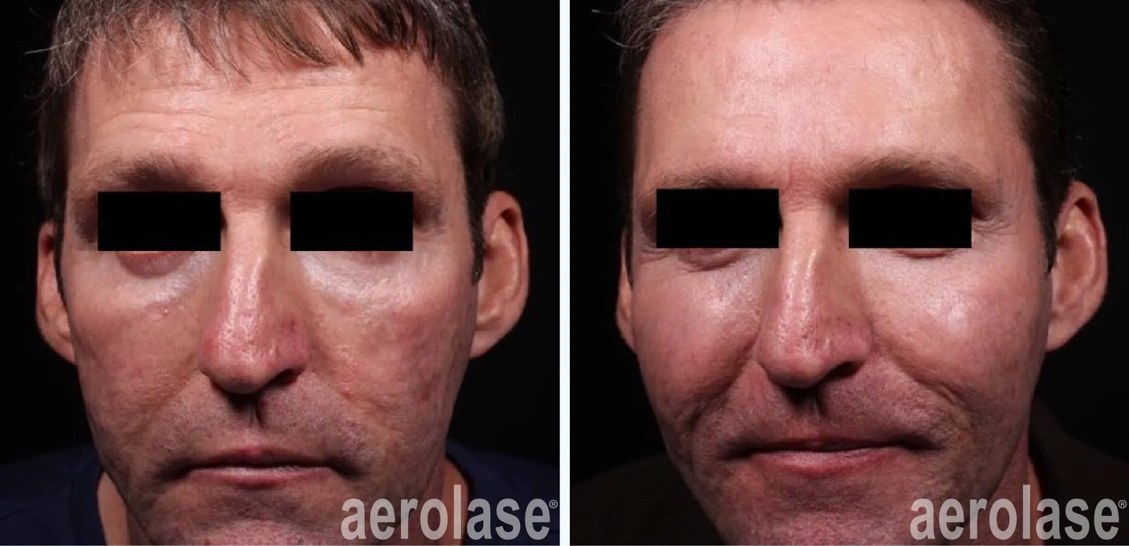 Advanced skin rejuvenation procedure