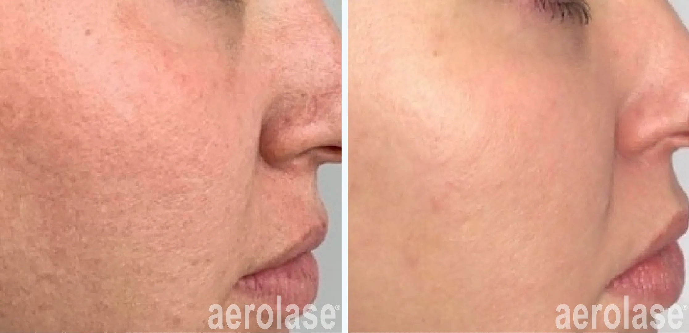 Skin Rejuvenation