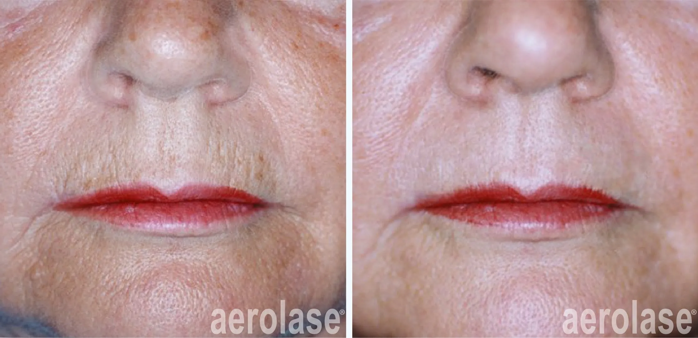 Fine line and wrinkle treatment