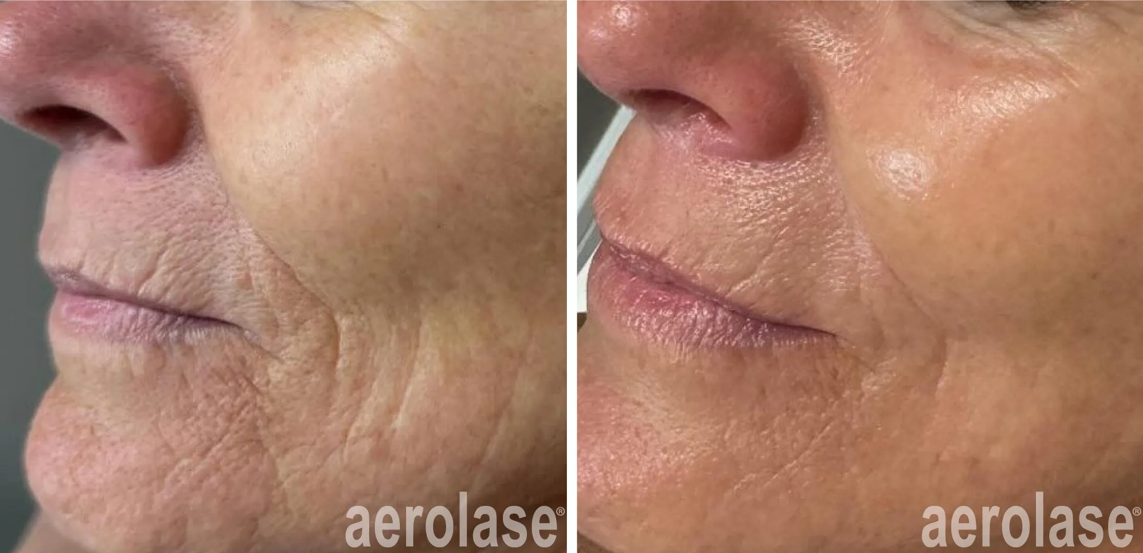 Skin Care Treatment for Wrinkles