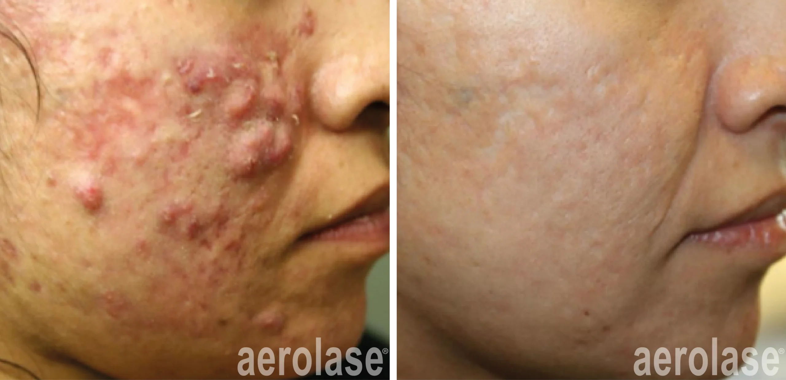 Breakthrough Acne Solution Before and After