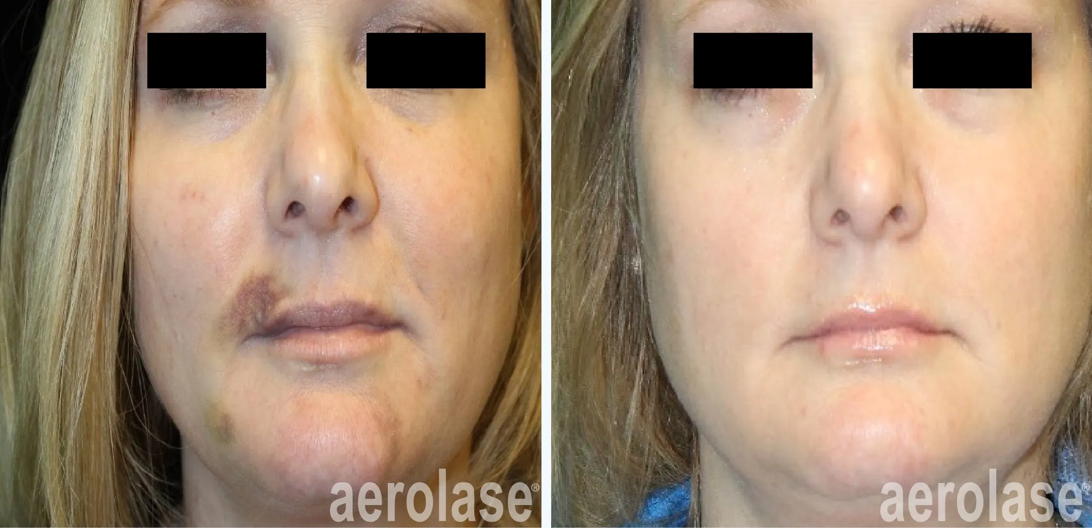 Bruising​ Treatments