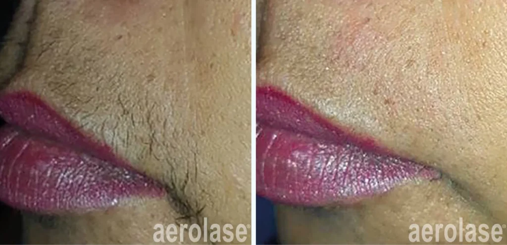 Laser Hair Removal
