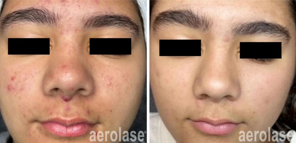 Reduces Inflammation & Calms Redness