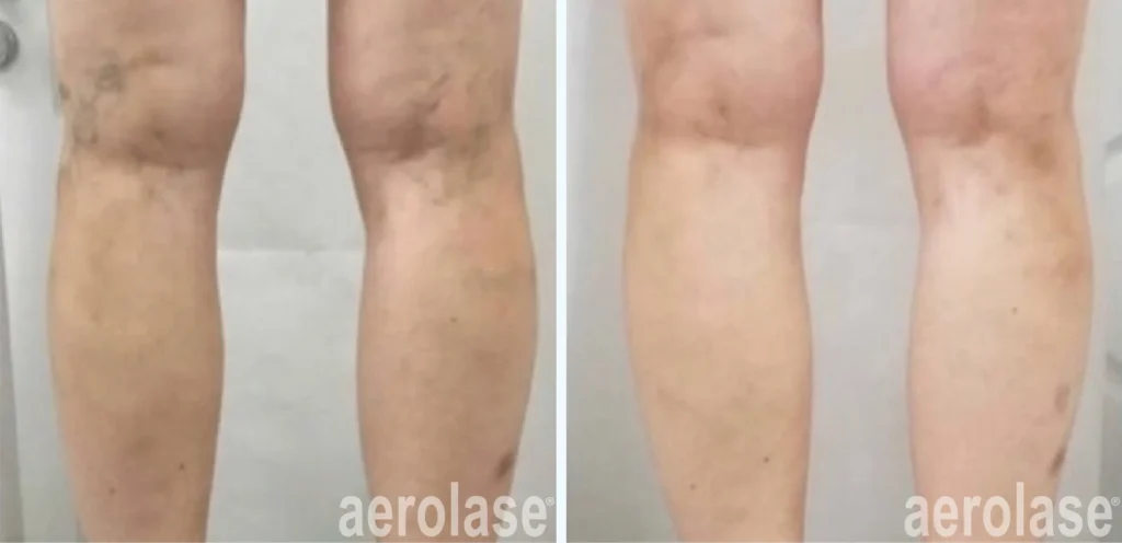 Leg Veins Treatments