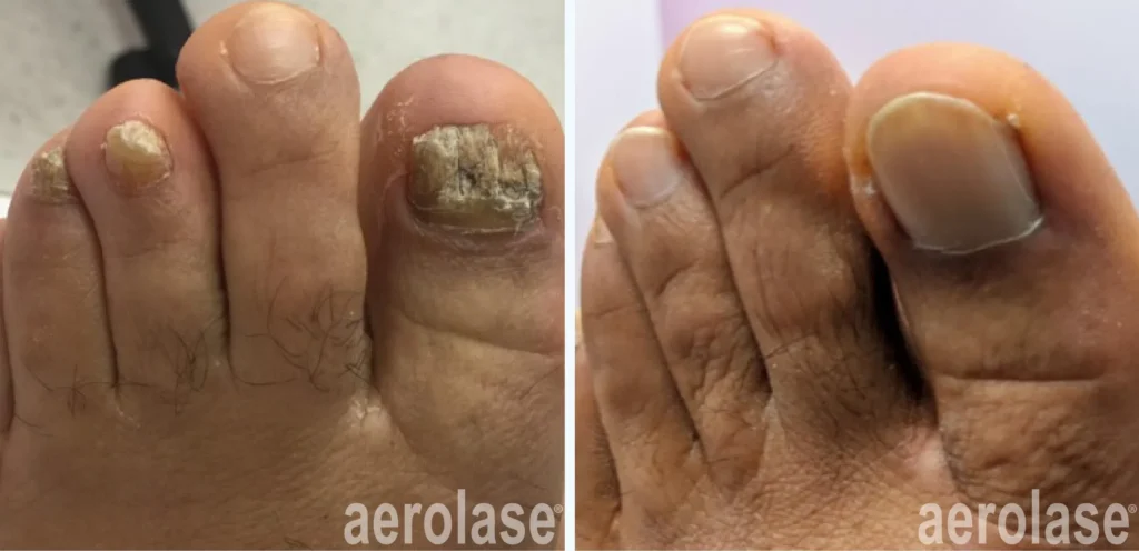 Nail fungus treatments