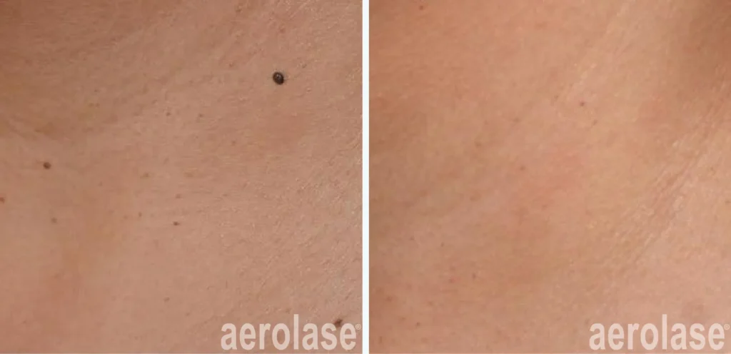 Skin tag treatment