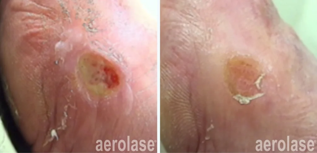 Ulcers & Wound Treatment