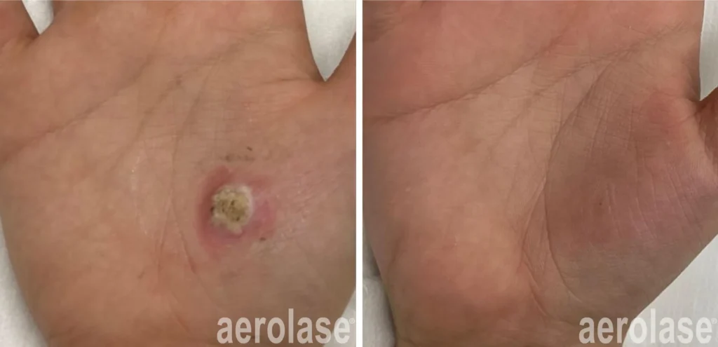 Warts Treatment