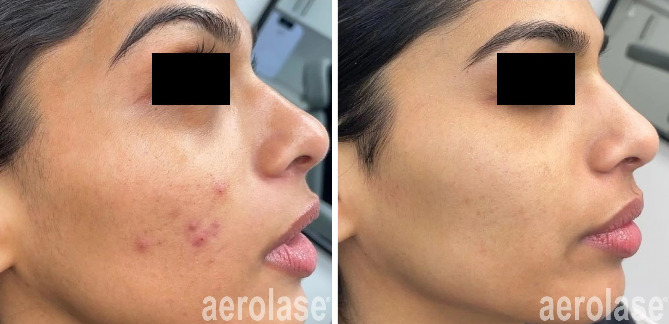 acne before and after Injector Zoe and The Indigo Clinic