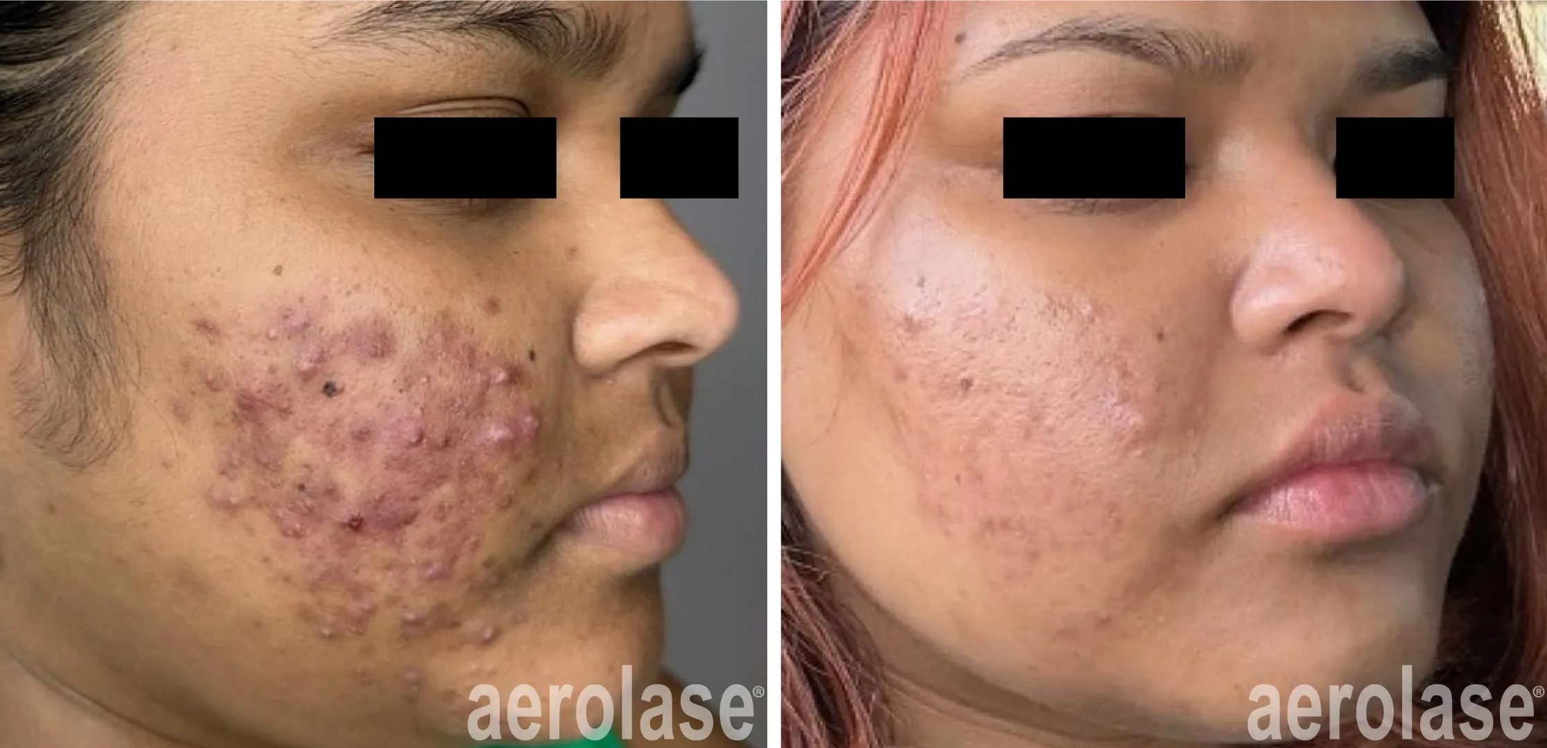 acne treatment Idun Aesthetics