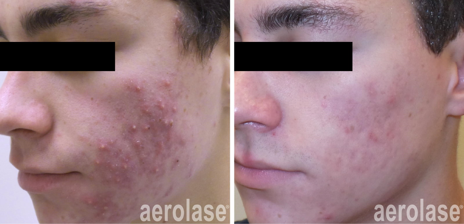 Skin needling for acne scars