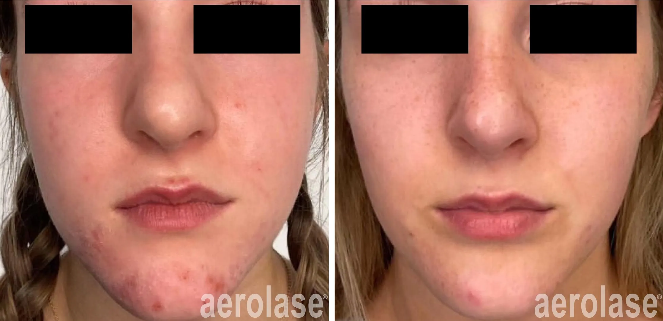 acne skin treatment before and after