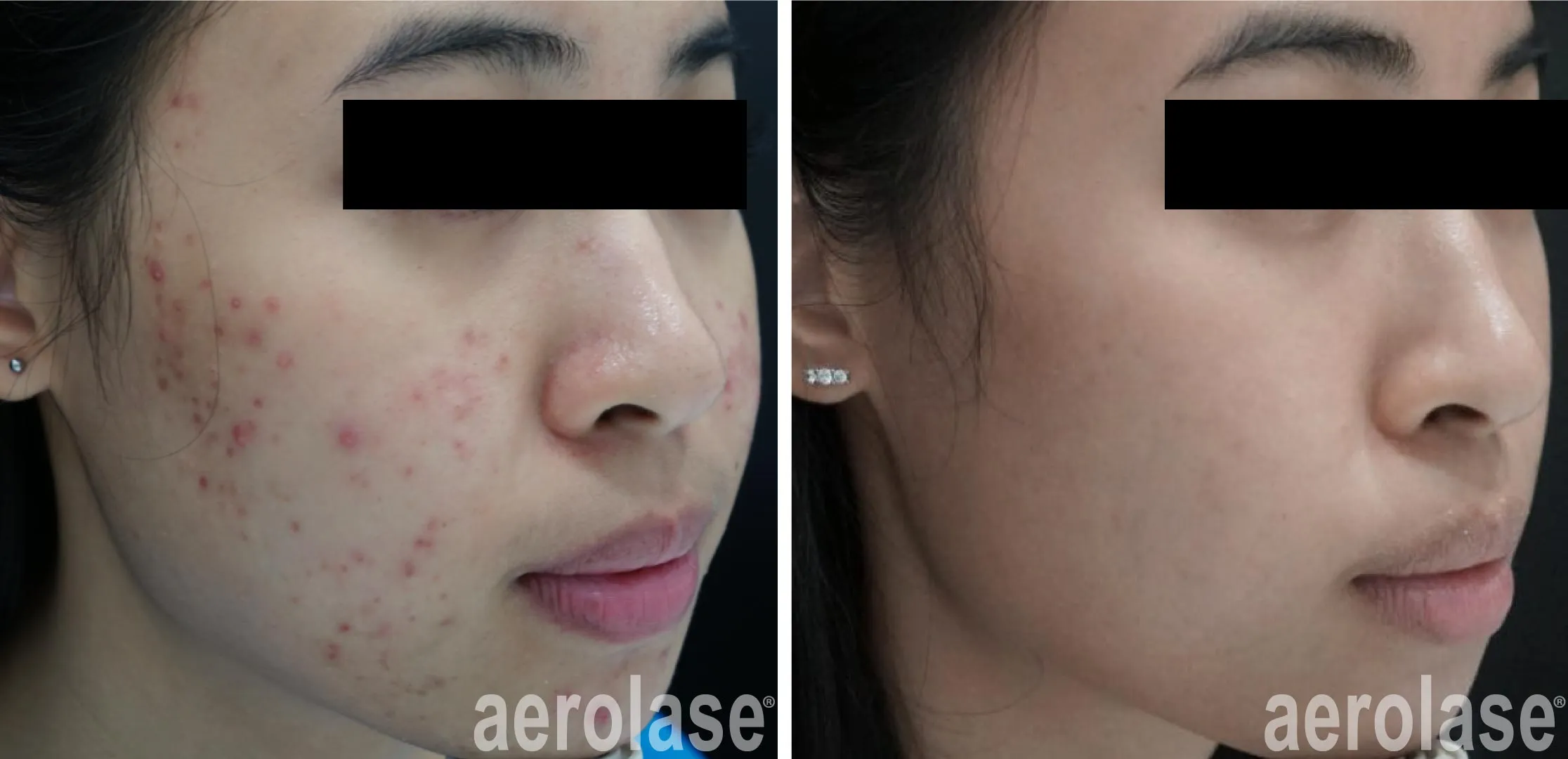 Microneedling before and after results