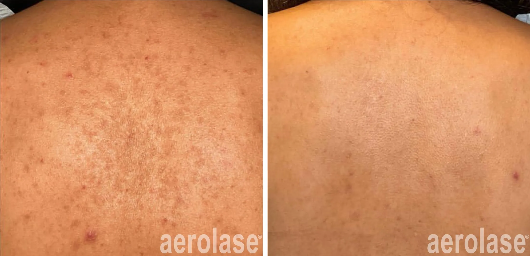 Aerolase Pigmentation Treatment