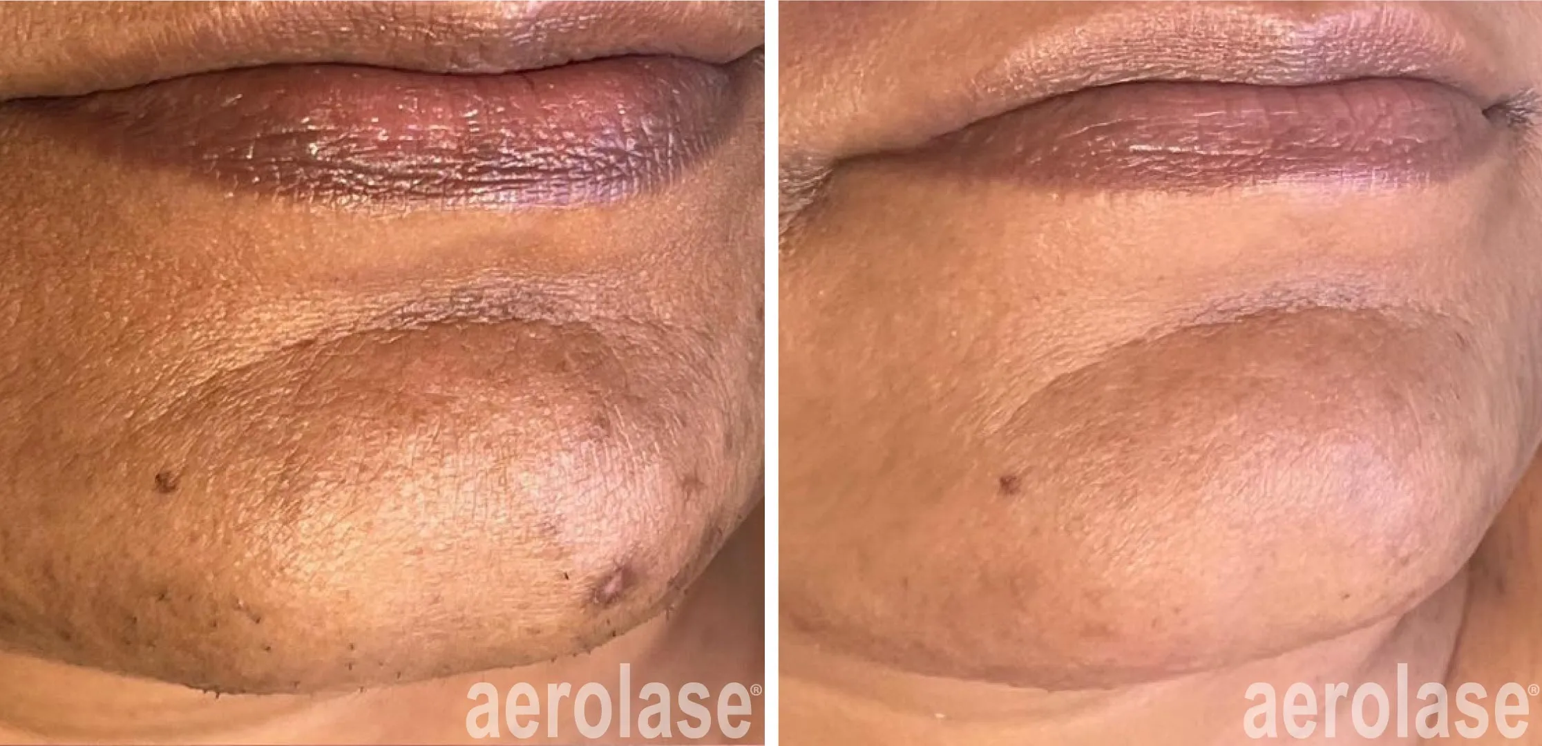 Microneedling for pigmentation correction
